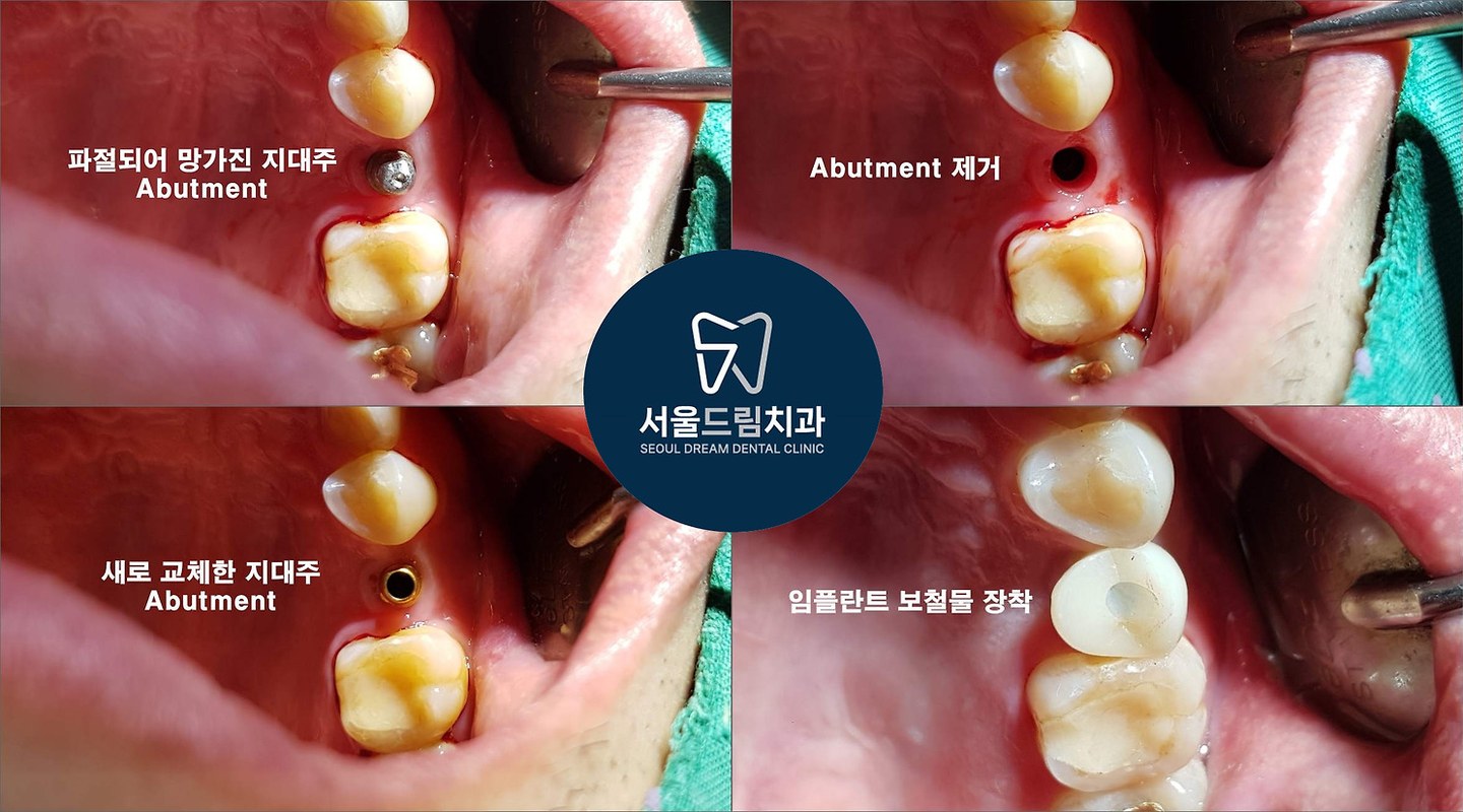 파절된 지대주 제거 후 새 지대주로 교체하고 보철물을 장착하기까지의 4단계 임상 사진