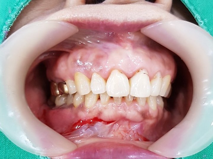 치료 전 — 앞니 심미보철 · 좌측면