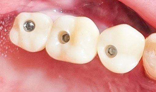 치료 후 — 구치부 임플란트 3개 식립 → 보철